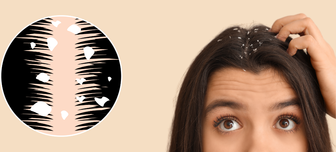 Dandruff and Urticaria Treatment
